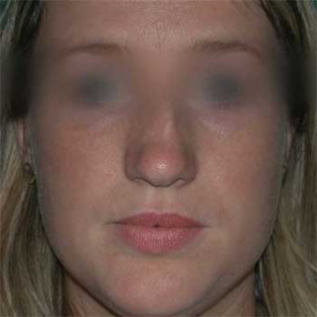 Front view before rhinoplasty surgery