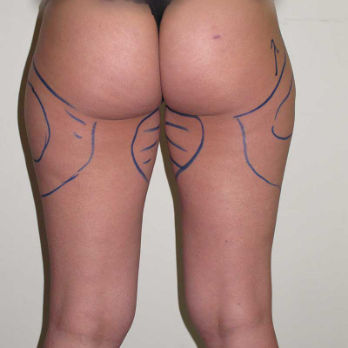 Back view of patient prior to VASER Liposelection surgery