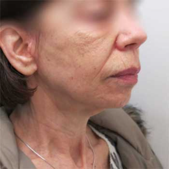 Side view of female paitent after Facelift surgery