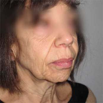 Side view of female paitent before Facelift surgery