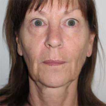 front view of female patient prior to Facelift surgery