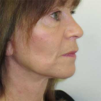 Side view of female paitent after Facelift surgery