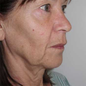 Side view of female paitent before Facelift surgery