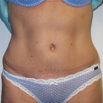 Front view of patient after Abdominoplasty surgery