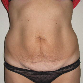 Front view of patient prior to Abdominoplasty surgery