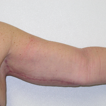 Front view of patient after Brachioplasty Arm Lift surgery