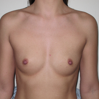 Front view of patient prior to Breast Augmentation surgery