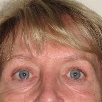 Front view of female patient after browlift surgery