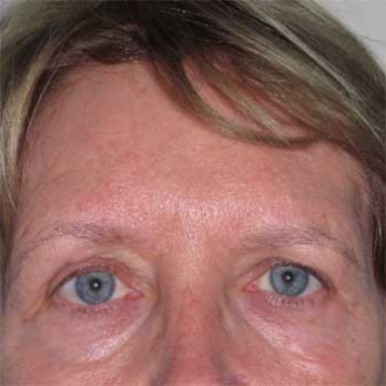 Front view of female patient prior to browlift surgery