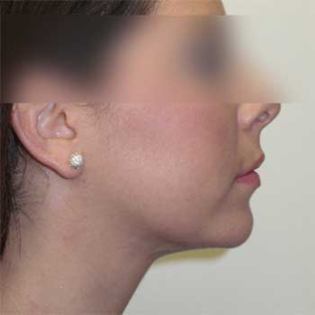 Side view of female patient after chin implant surgery