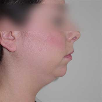 Side view of female patient prior to chin implant surgery