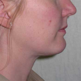 Side view of female patient after VASER chin and neck liposuction surgery