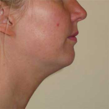 Side view of female patient before VASER chin and neck liposuction surgery