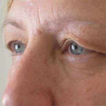 Side view of female patient prior to eyelid surgery