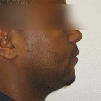 Side view of male patient after Facial Liposculpture surgery