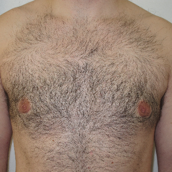 Front view of male patient after gynaecomastia surgery