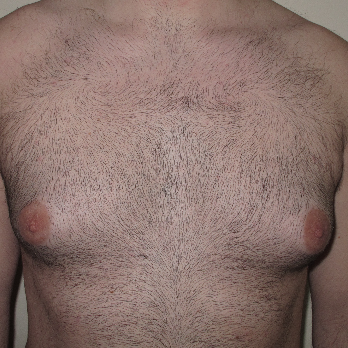 Front view of male patient prior to gynaecomastia surgery