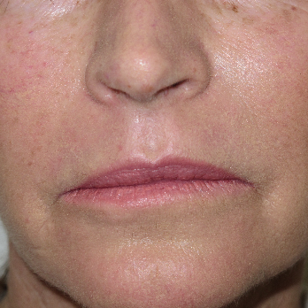 Front view of patient after Fractional laser resurfacing treatment