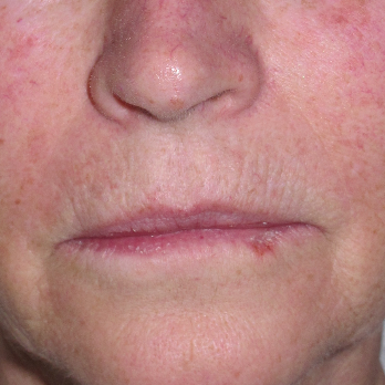 Front view of patient prior to Fractional laser resurfacing treatment