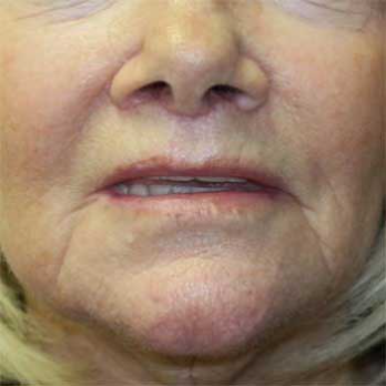 Front view of 72 year old female patient after lip lift surgery