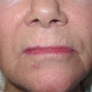 Front view of 72 year old female patient prior to lip lift surgery