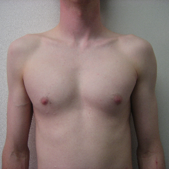 Front view of male patient after pectoral implant surgery