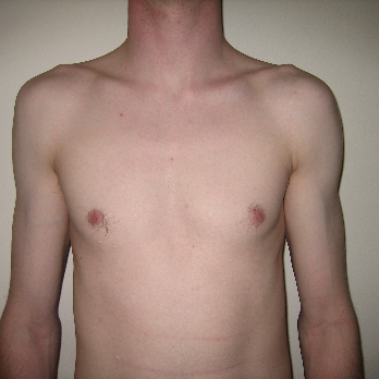 Front view of male patient prior to pectoral implant surgery