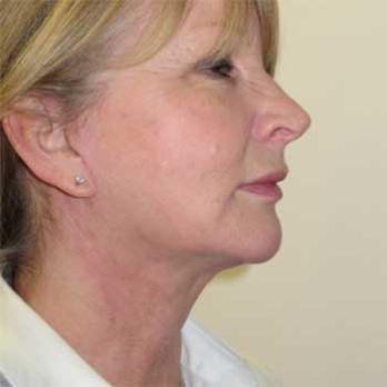 Side view of female patient after necklift, lower facelift and submental liposuction