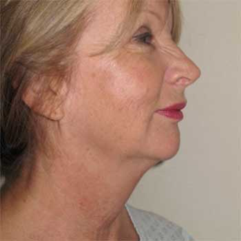 Side view of female paitent before necklift, lower facelift and submental liposuction