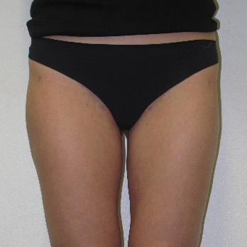 Back view of patient after VASER Liposelection surgery