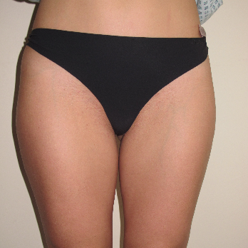 Back view of patient prior to VASER Liposelection surgery