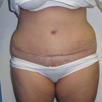 Front view of patient after Abdominoplasty surgery