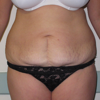 Front view of patient prior to Abdominoplasty surgery