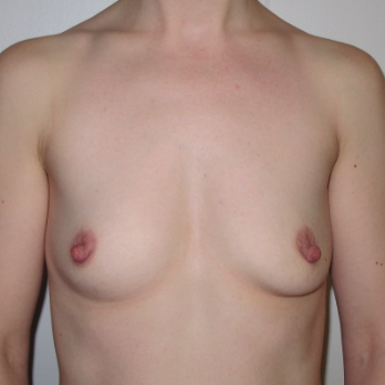 Front view of patient prior to Breast Augmentation surgery