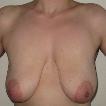 Front view of patient prior to breast lift surgery