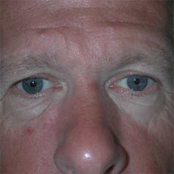 Front view of male patient prior to browlift surgery