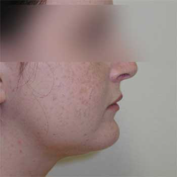 Side view of female patient after chin implant surgery