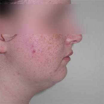 Side view of female patient prior to chin implant surgery