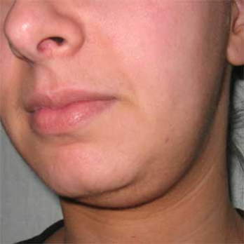 Quarter view of 22 year old prior to chin liposuction surgery