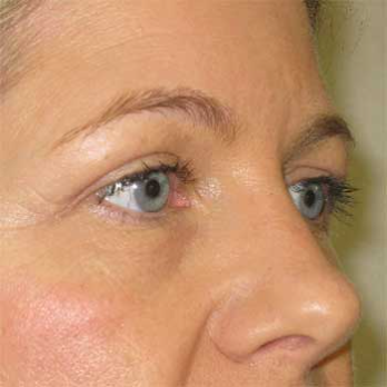 Side view of female patient after eyelid surgery