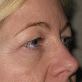 Side view of female patient prior to eyelid surgery