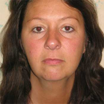 front view of female patient prior to Facelift surgery