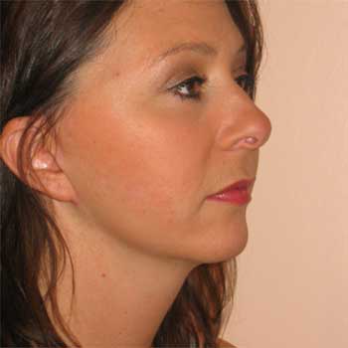 Side view of female paitent after Facelift surgery