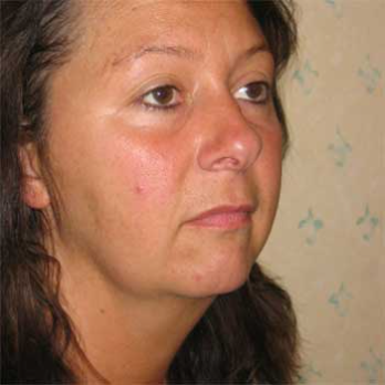 Side view of female paitent before Facelift surgery
