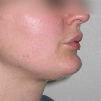 Side view of female patient after Facial Liposculpture surgery