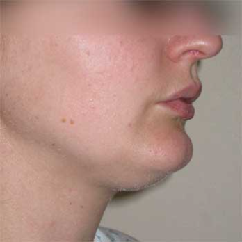 Side view of female patient prior to Facial Liposculpture surgery