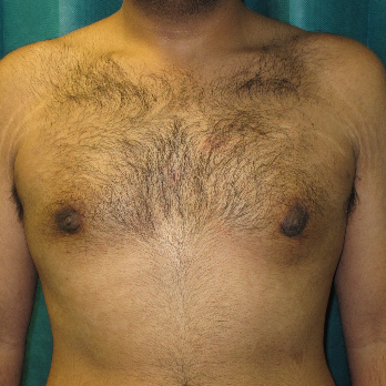 Front view of male patient after gynaecomastia surgery