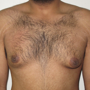 Front view of male patient prior to gynaecomastia surgery