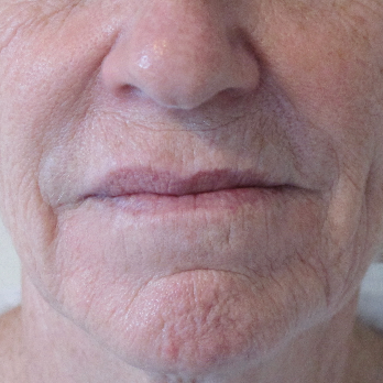 Front view of patient prior to Fractional laser resurfacing treatment