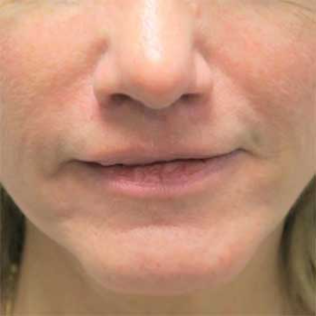 Front view of 56 year old female patient after lip lift surgery